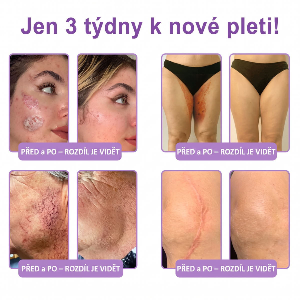 Vitalisys®🔥PDRN Multi-Peptide Masážní tělový krém s válečkem — proti stárnutí, hydratuje, zpevňuje a liftinguje pokožku, podporuje regeneraci, sjednocuje tón pleti a pečuje o nedokonalosti a tmavé skvrny.